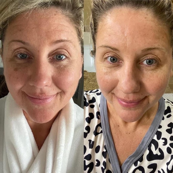 AT HOME FACIAL PEEL